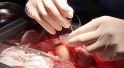 У лікарні швидкої медичної допомоги хірурги вперше провели забір нирки для трансплантації лапароскопічно